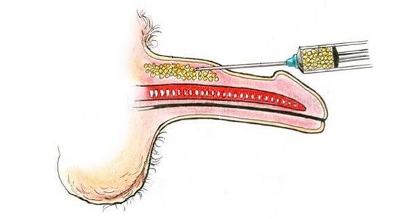 Hyaluronic acid injections to a member's barrel to increase it
